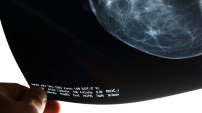 Mammogram